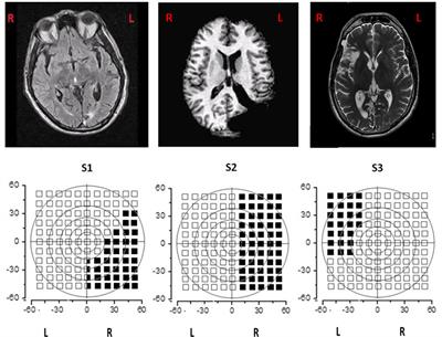 Development and Implementation of a New Telerehabilitation System for Audiovisual Stimulation Training in Hemianopia